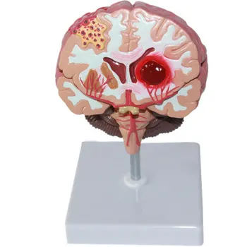 Модель человеческого мозга Патология головного мозга бесплатная доставка